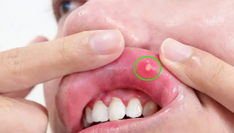 Kanserin Belirtilerini Göz Ardı Eden Adamın Yaşadığı Şok: Dilini Kaybetti