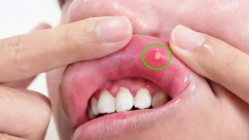 Vücudunuzda B Vitaminleri Eksik Mi? İşte 5 Belirgin Belirti!